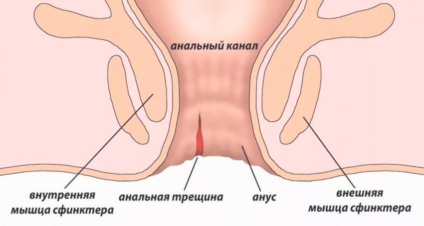 У ребенка после стула кровь на попе